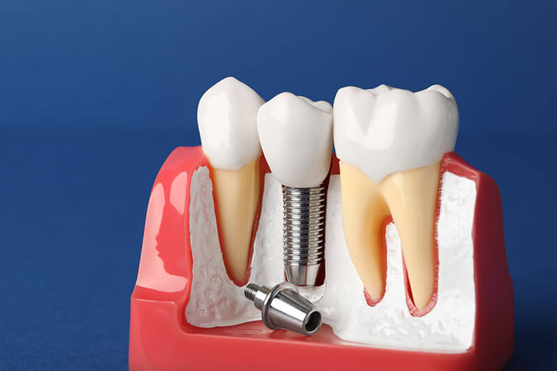 Five Tips for Looking After Dental Implants in Burlington - Dentist Burlington - Lakeside Family Dental