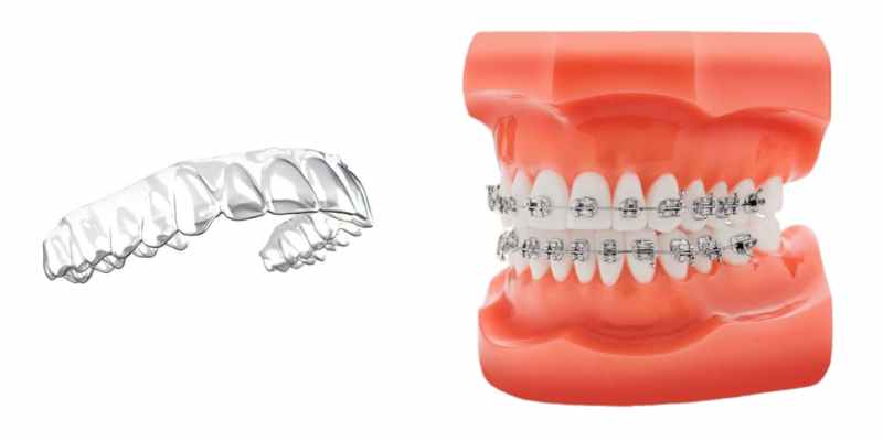 A comparison photo between the clear aligners and Braces.